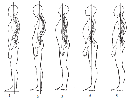 Два позвоночника у человека. Типы осанки по штаффелю. Нормальная осанка сбоку. Типы осанки человека по штаффелю. Искривление позвоночника плоская спина.